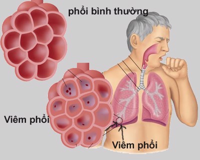 Những cơn ho do viêm phổi và viêm phế quản ảnh hưởng như thế nào tới chuyện chăn gối?